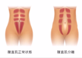 腹肌分离怎么修复？
